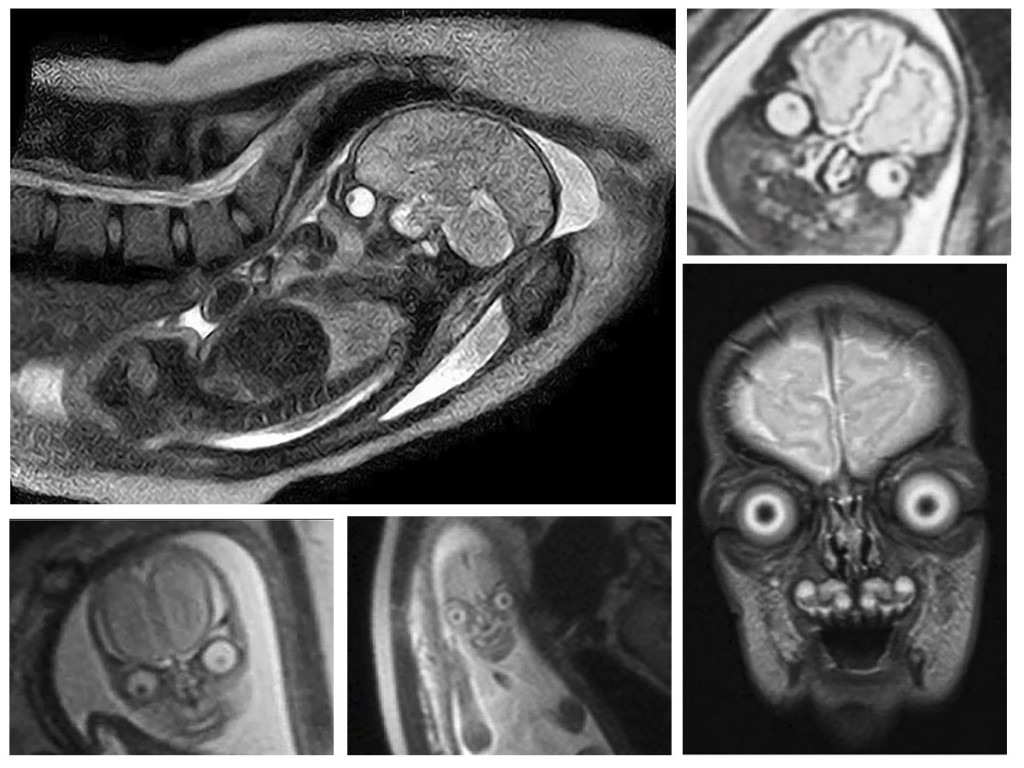 Slike bebe nastale MRI skeniranjem uznemirile mreže